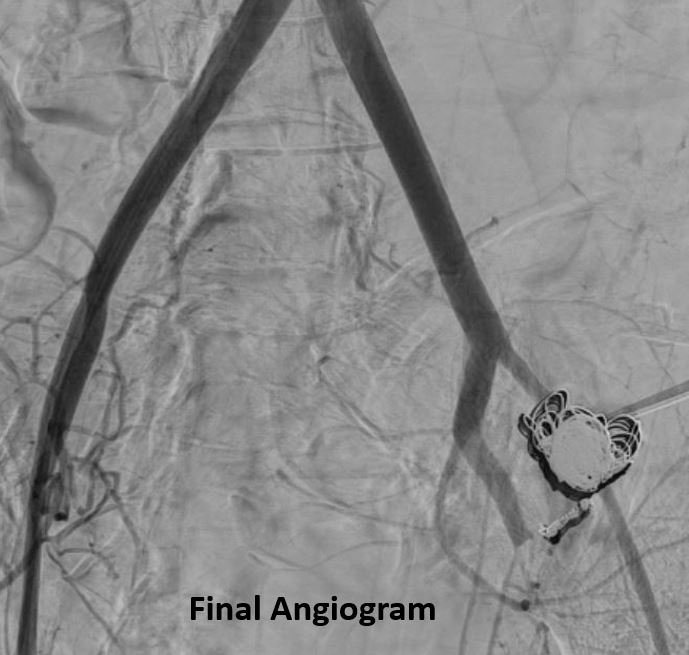 University of Arizona VIR (@arizonavir) on Twitter photo G1P1 desires fertility preservation s/p extended left c-section c/b unstable vaginal bleed.  Angio: large UA psA bleed. UA small/tortuous initially s/p endo prox coil; however, persistent bleed s/p definitive perc. stick & coil
<a href="/HannallahMD/">Jack Hannallah MD MBA MPH</a> <a href="/woodhead/">Gregory J. Woodhead</a> <a href="/shamaryoungmd/">Shamar Young MD</a> <a href="/goldmembermd/">Dan Goldberg</a> G1P1 desires fertility preservation s/p extended left c-section c/b unstable vaginal bleed.  Angio: large UA psA bleed. UA small/tortuous initially s/p endo prox coil; however, persistent bleed s/p definitive perc. stick & coil
<a href="/HannallahMD/">Jack Hannallah MD MBA MPH</a> <a href="/woodhead/">Gregory J. Woodhead</a> <a href="/shamaryoungmd/">Shamar Young MD</a> <a href="/goldmembermd/">Dan Goldberg</a>