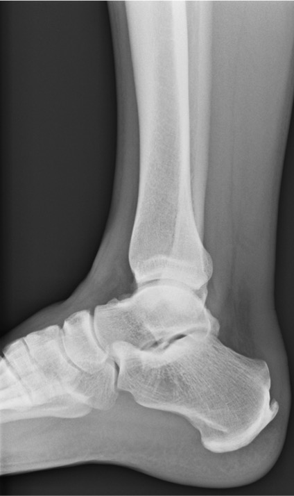 A 38 M was playing soccer and swears he was hit from behind. See anything on these x-rays? What's the diagnosis? What would you do? #MedTwitter #orthotwitter