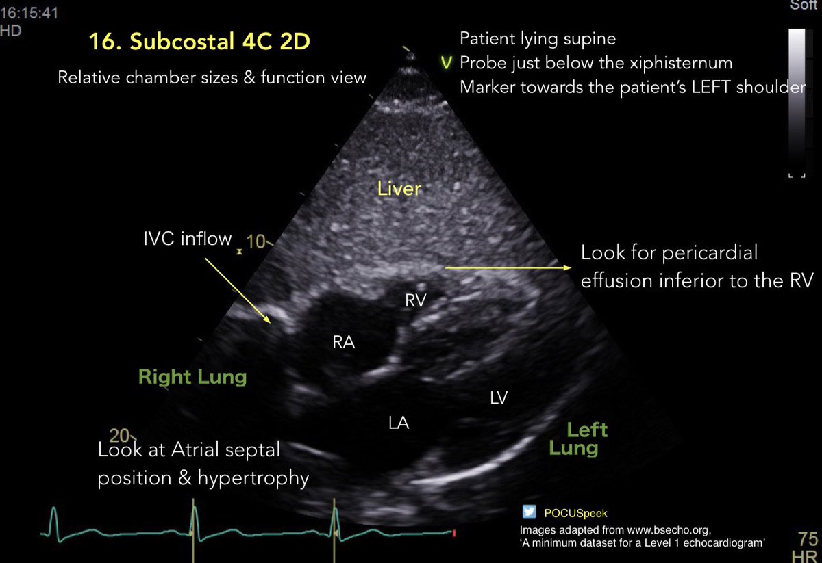 POCUSpeek's tweet image. Some annotated #firstecho #POCUS main views 👇🏻 3/3