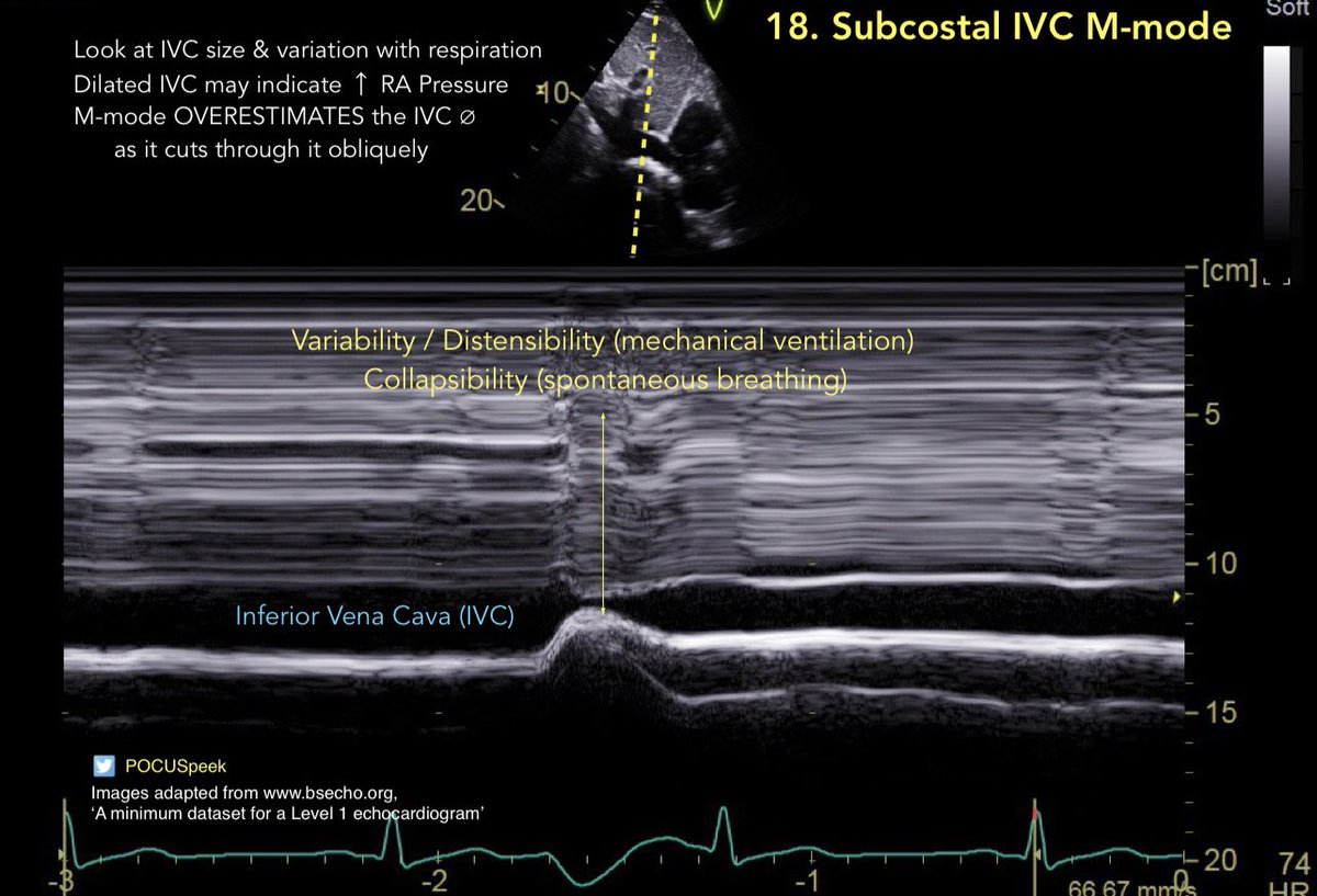 POCUSpeek's tweet image. Some annotated #firstecho #POCUS main views 👇🏻 3/3