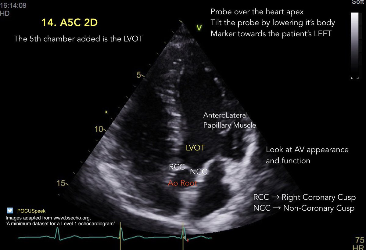POCUSpeek's tweet image. Some annotated #firstecho #POCUS main views 👇🏻 3/3