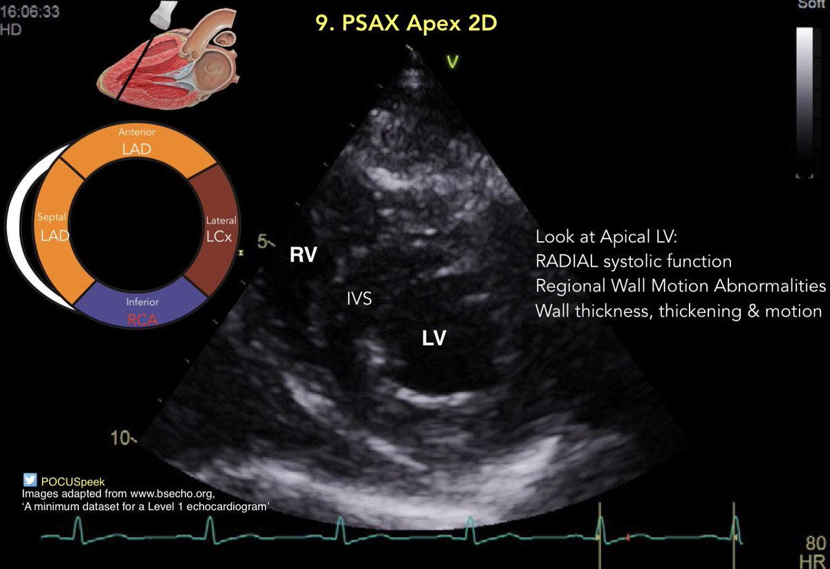 POCUSpeek's tweet image. Some annotated #firstecho #POCUS main views 👇🏻 2/3