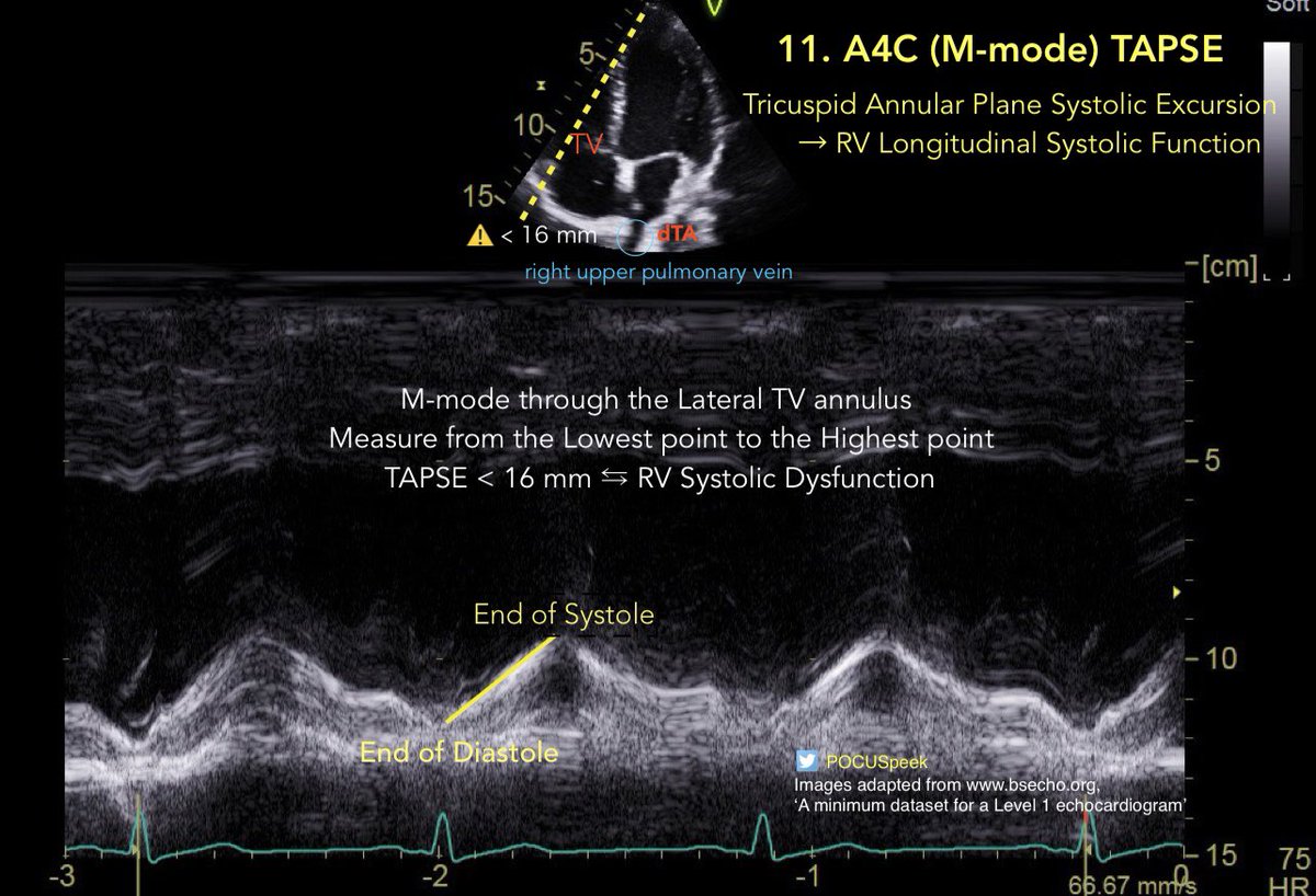 POCUSpeek's tweet image. Some annotated #firstecho #POCUS main views 👇🏻 2/3