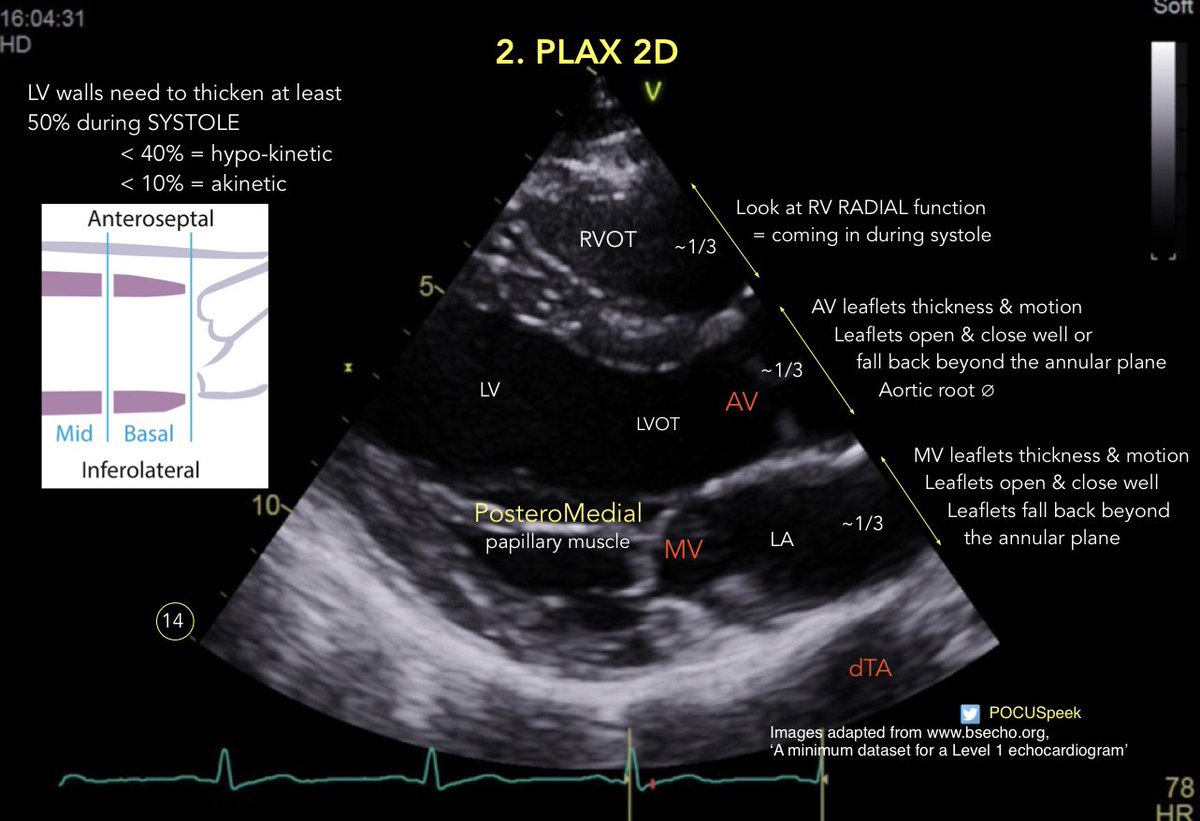 POCUSpeek's tweet image. Some annotated #firstecho #POCUS main views 👇🏻1/3