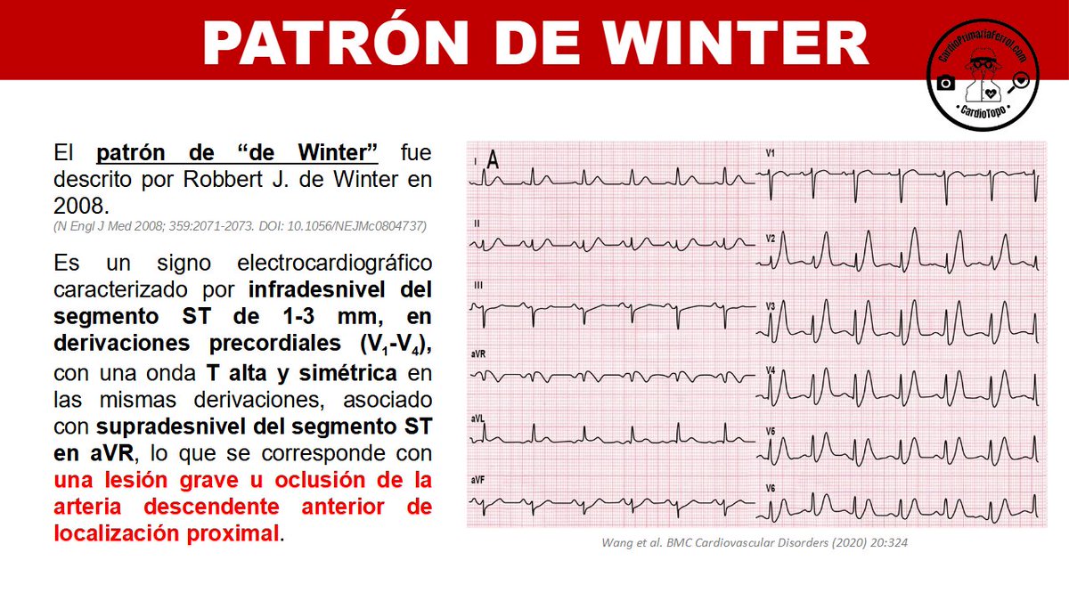 CardioAPFerrol's tweet photo. Uno de esos patrones ECG que debemos reconocer a simple vista por su gravedad y necesidad de estrategia terapéutica precoz es el patrón De Winter ☃️

Recuerda:
❄️ Infradesnivel ST 1-3 mm en V1-4
❄️ T alta y simétrica en V1-4
❄️ Supradesnivel ST en aVR https://t.co/61pMZHuH63