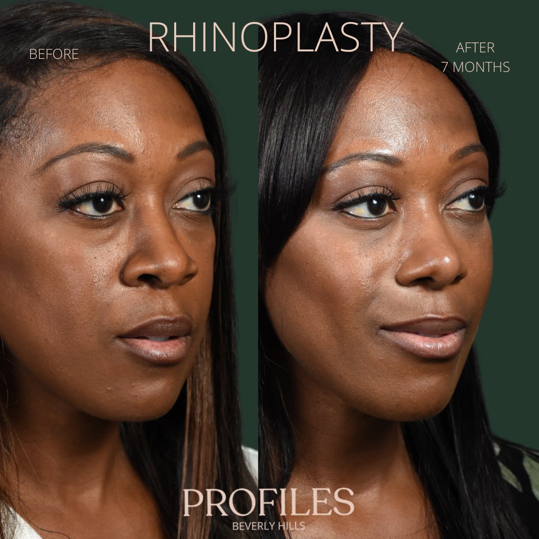 FacialPlastics's tweet photo. 📞310-276-6800
🏠 435 N Bedford Drive, PH500, Beverly Hills, 90210
👃Rhinoplasty
🗓 Before and After 7 Months
🛏 About 1 week, the cast gets taken off after 6 days

Swipe ⏩⏩⏩ for more views

Call or DM us to schedule your consultation

We also offer virtual co... https://t.co/lrbV8K8qqp