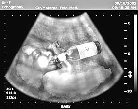 doctorneyro's tweet photo. @isanidad @VisualTeaf La #educaciónsanitaria debiera #enseñar a las #parejas que tratan de #concebir que no debieran #beberalcohol desde cada #ovulación hasta el final del #ciclomenstrual y la #regla.
Durante el #embarazo (aún todavía desconocido), #alcoholcero.
https://t.co/ylZRfD4W7X https://t.co/k2X0UcyEn8