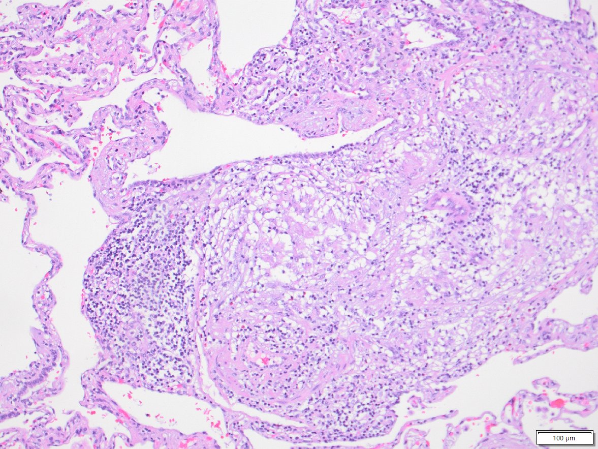 Modern targeted therapy has revolutionized cancer treatment. However every potent treatment can have side effects.
This is an example of drug induced lung injury in a patient treated with abemaciclib showing pneumonitis, fibrinous and FOP and granuloma.
#PathTwitter #ThoracicPath