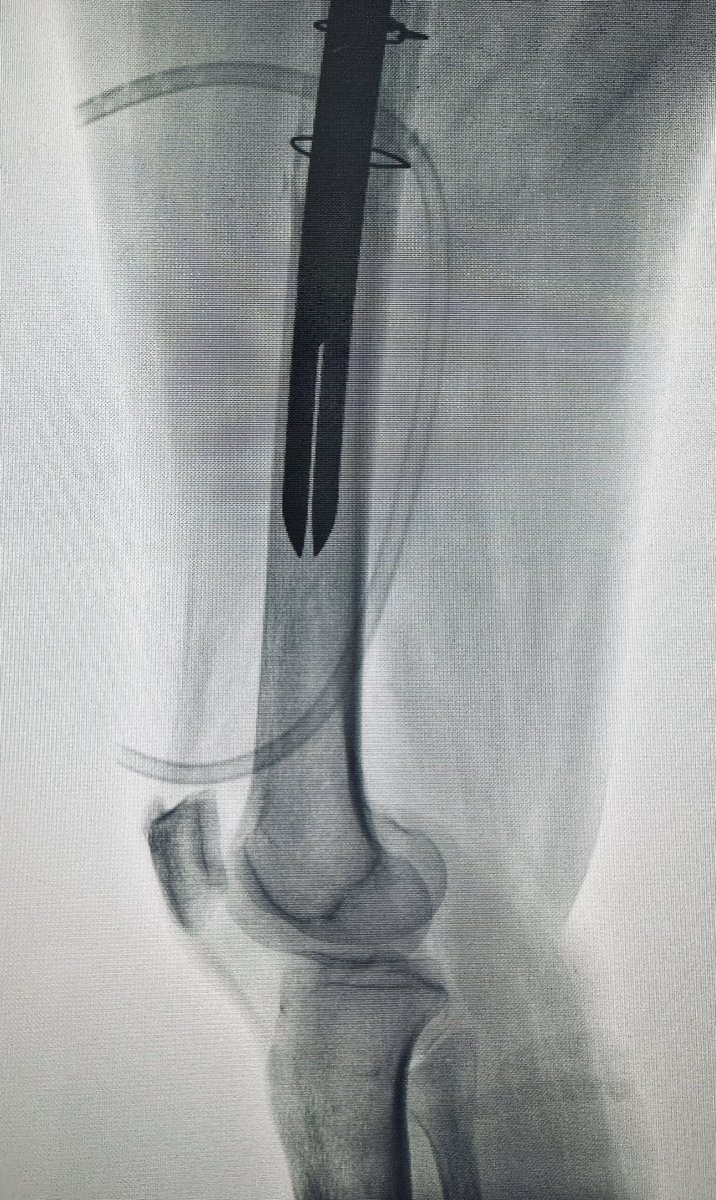 La revisión de cadera nuestra de cada día !
