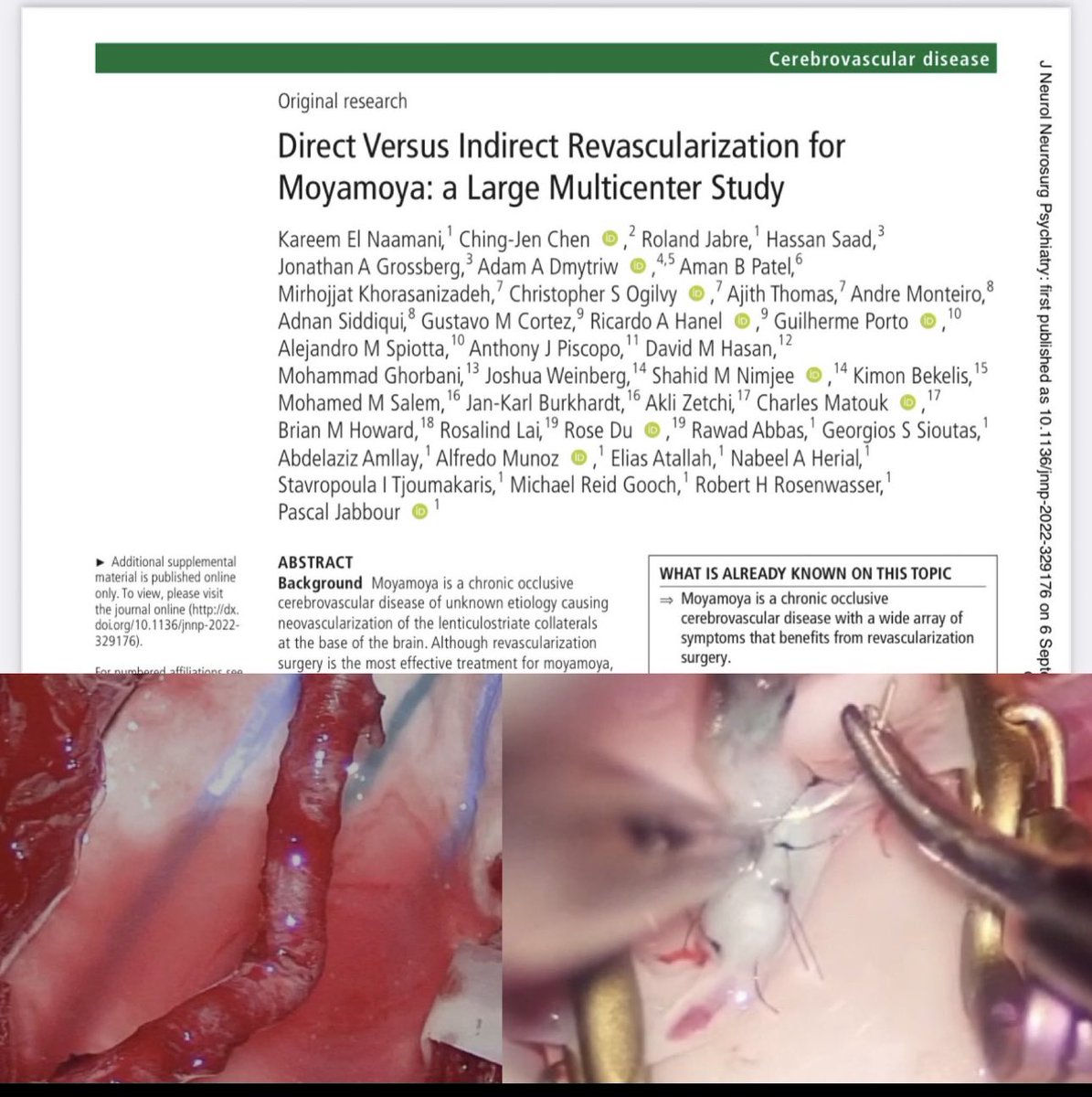 mohghorbany's tweet image. So proud to be part of this valuable work headed by Pr. Pascal and Dr. Naamani about moyamya disease treatment and comparison of results of different techniques of surgery #moyamoya #revascularization @PascalJabbourMD @KareemNaamaniMD