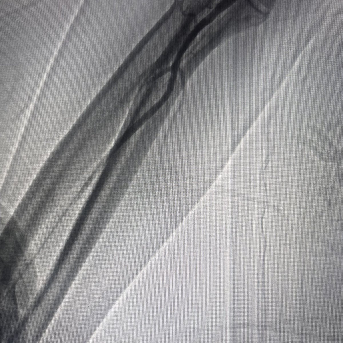 alexdica69_diaz's tweet photo. @UMAEMid_CathLab 71M, angina class III. CAG 4 days ago #Ddtra . #LM with #calcification. #GABC rejected. Today #TRA #IVUS guided #PCI #TAP
@latambifclub @alexdica69_diaz @MauroEchavPinto @UMAESon_CathLab
@umae34cathlab
@mornei2011 @HemoMacGregor @cardioelihu https://t.co/ApRn62lfgy