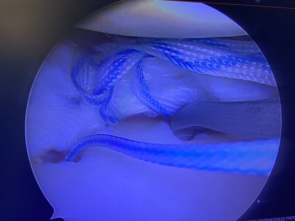 DrNickColyvas's tweet photo. 2 tunnels, 2 months later
Happy patient
#rootrepair https://t.co/Mdi3xFGgTr