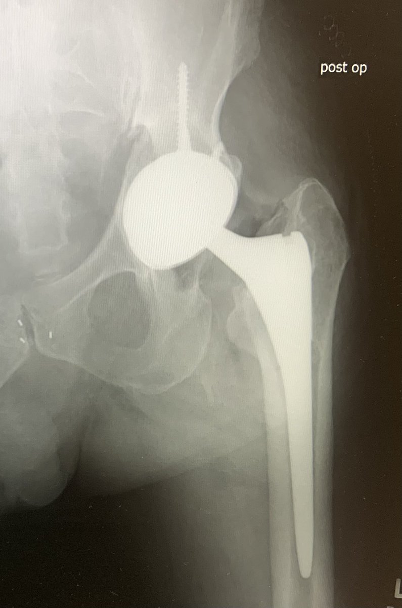 Recently used navigation for the first time in hip revision. #orthotwitter 
@generalorthomd @HipReplacement @intellijoint @DeviceNation @NaanDerthaal @jointdocShields