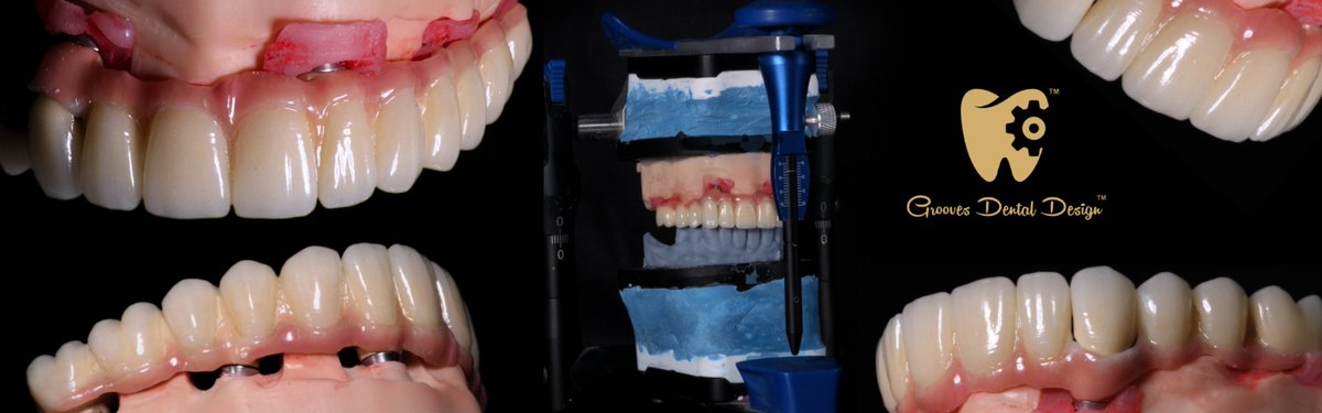 GroovesDental's tweet image. Grooves DMlS ✨

Digital file use groovescadcam@gmail.com

More details DM me 📩 and also use---info@groovesdentaldesign.com

#dentistry #dmls