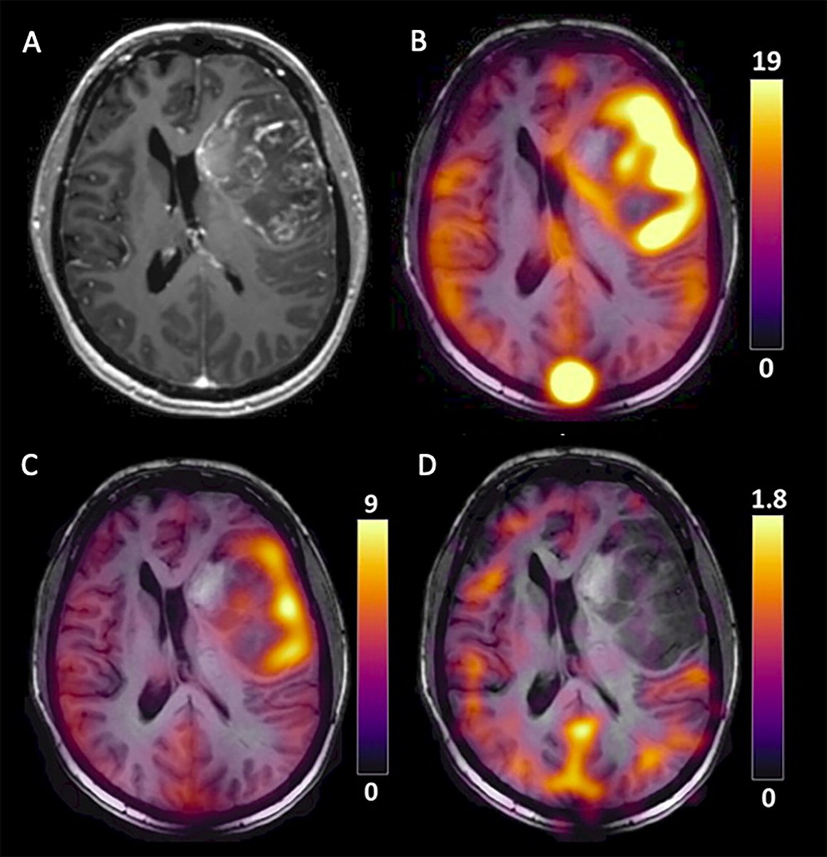 Hyperpolarized carbon 13 MR images in a patient with glioblastoma that demonstrate heterogeneity in metabolism.

Hyperpolarized Carbon 13 MRI: Clinical Applications and Future Directions in Oncology | Radiology: Imaging Cancer pubs.rsna.org/doi/10.1148/ry…