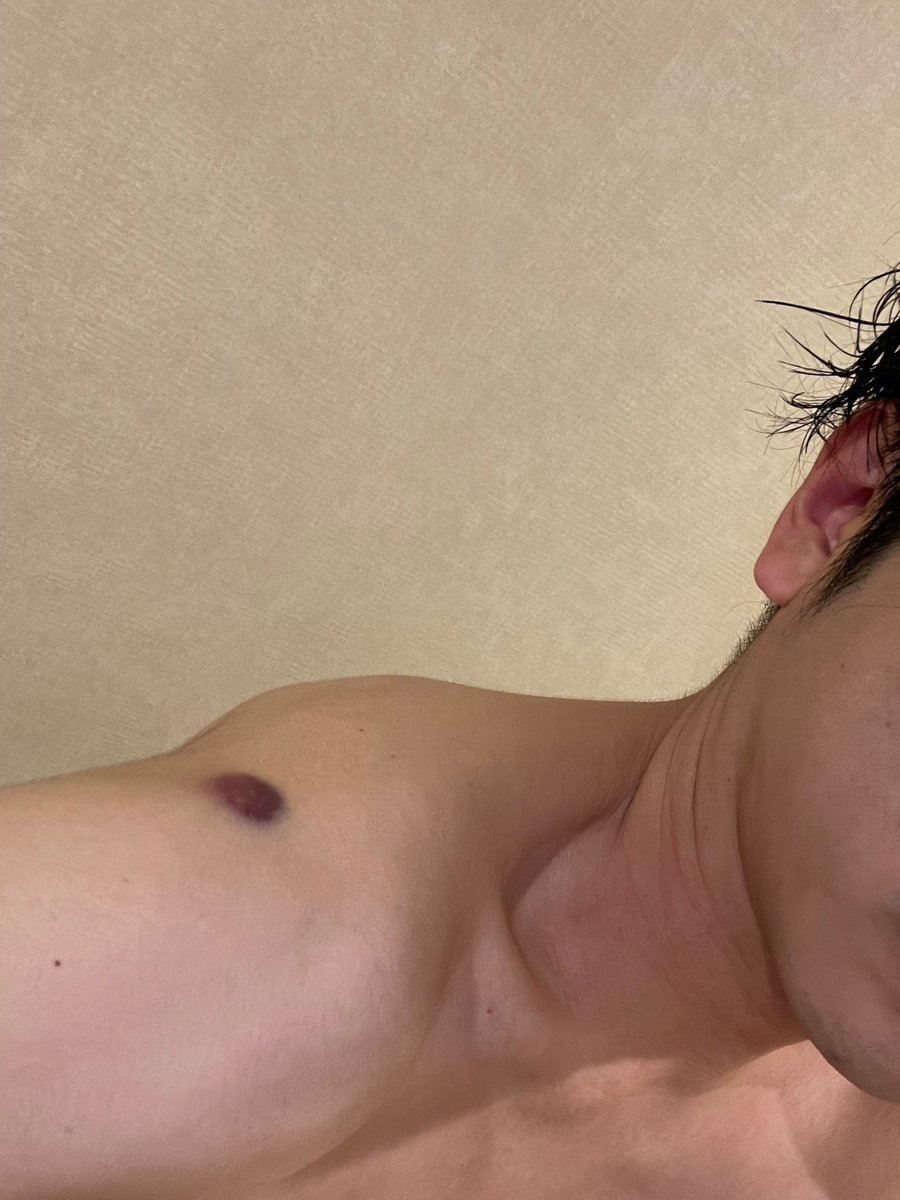 nino_honmono's tweet photo. アクション俳優だからしょうがないぜ…
傷を治すまでがプロってもんさ(どうしたらいいか誰か教えてくれ) https://t.co/jKiLqdJTym