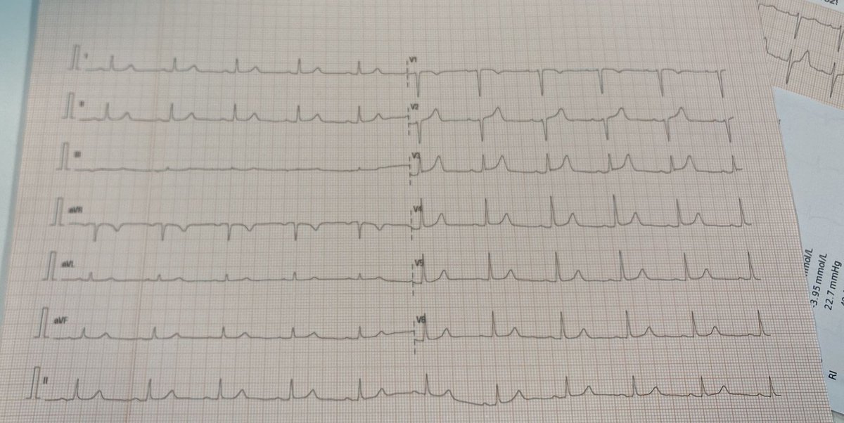 stefano parlamento (@palamuto) on Twitter photo Good morning OMI Friends. 50yrs cp. Previous ablation for wpw. What do you think of that precordial st-t?(my guess: not OMI)<a href="/PendellM/">Pendell Meyers</a> <a href="/RobertHermanMD/">Robert Herman, MD, PhD</a> <a href="/smithECGBlog/">Stephen W. Smith</a> <a href="/The_Nanashi_O/">Nanashī🫀</a> <a href="/EM_RESUS/">Sam Ghali, M.D.</a> Good morning OMI Friends. 50yrs cp. Previous ablation for wpw. What do you think of that precordial st-t?(my guess: not OMI)<a href="/PendellM/">Pendell Meyers</a> <a href="/RobertHermanMD/">Robert Herman, MD, PhD</a> <a href="/smithECGBlog/">Stephen W. Smith</a> <a href="/The_Nanashi_O/">Nanashī🫀</a> <a href="/EM_RESUS/">Sam Ghali, M.D.</a>