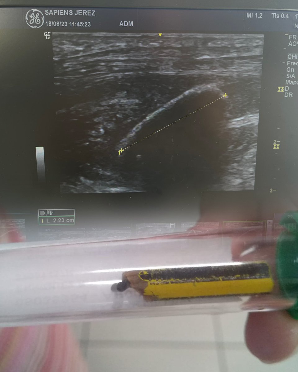 Hace unos dias nos llegó un chico con 8 meses de dolor en el pie. Justamente tambien pisó una maleta 8 meses atrás. 
Resultado de la exploración? 
Un lapiz ✏️ de >2,5cm