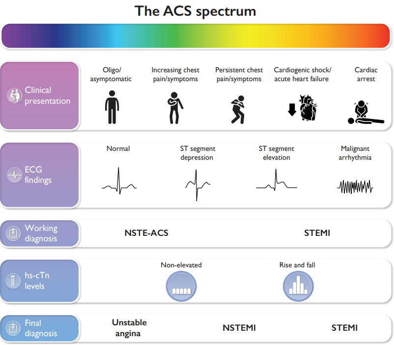 cardioteca's tweet image. Un ECG normal NO excluye un síndrome coronario agudo. 

Alrededor del 30% de los pacientes con infarto sin elevación del ST tienen un ECG normal.

🔓 escardio.org/Guidelines/Cli…