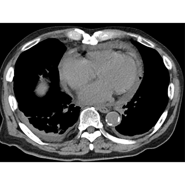A 77-year-old man, who had catheter ablation of atrial fibrillation 2 weeks beforehand, was referred to a unit with dyspnoea and pyrexia. A chest CT under a longitudinal view was done.

Looking at the scan, what is the most likely diagnosis seen in this image? #TLClinicalPic