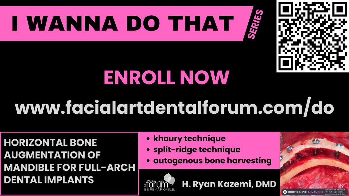Online modular course on horizontal bone augmentation for full-arch dental implants; Pre-launch enrollment now open with $100 off course fee. 14 lessons with immersive videos that will teach you the procedures, step-by-step. Enroll today.   #education #dental #Online #course