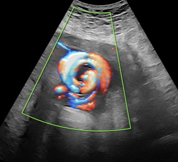 Images in Obstetrics:  Cyclone sign: prenatal ultrasound diagnosis of a true umbilical cord knot ow.ly/RshV50NKI0c