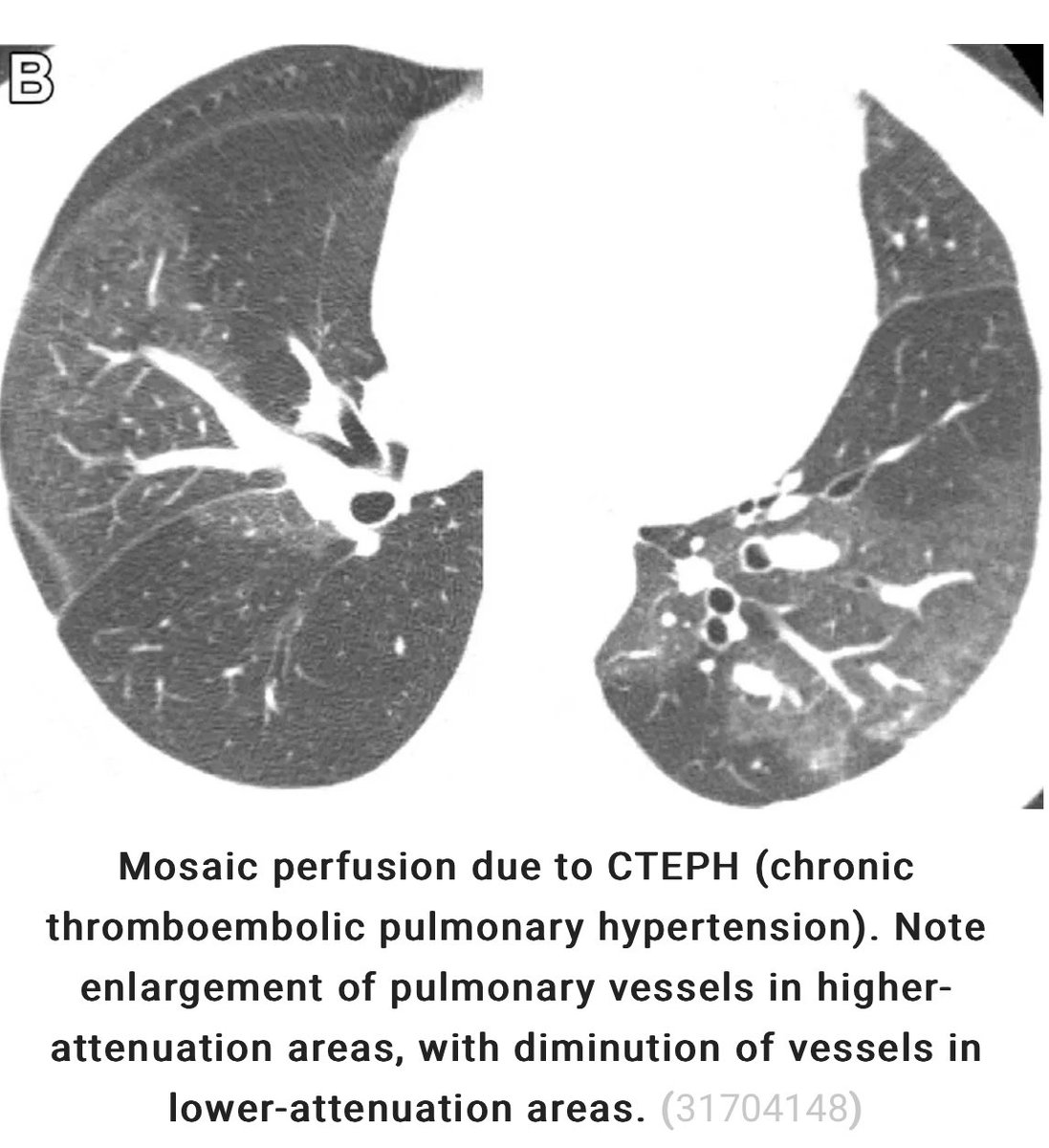 PulmCrit's tweet photo. new chapter: ground glass opacities (GGO)

☁️ GGO is enormously common (and no, it doesn’t mean that the patient has pneumocystis or COVID 🙄)

☁️subtypes help narrow the differential (eg diffuse GGO, mosaic pattern, crazy-paving, headcheese sign)

https://t.co/03CXykihNl #IBHP https://t.co/2T6ol6GKZW