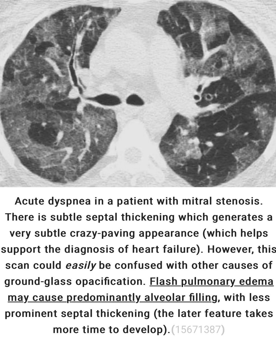 PulmCrit's tweet photo. new chapter: ground glass opacities (GGO)

☁️ GGO is enormously common (and no, it doesn’t mean that the patient has pneumocystis or COVID 🙄)

☁️subtypes help narrow the differential (eg diffuse GGO, mosaic pattern, crazy-paving, headcheese sign)

https://t.co/03CXykihNl #IBHP https://t.co/2T6ol6GKZW