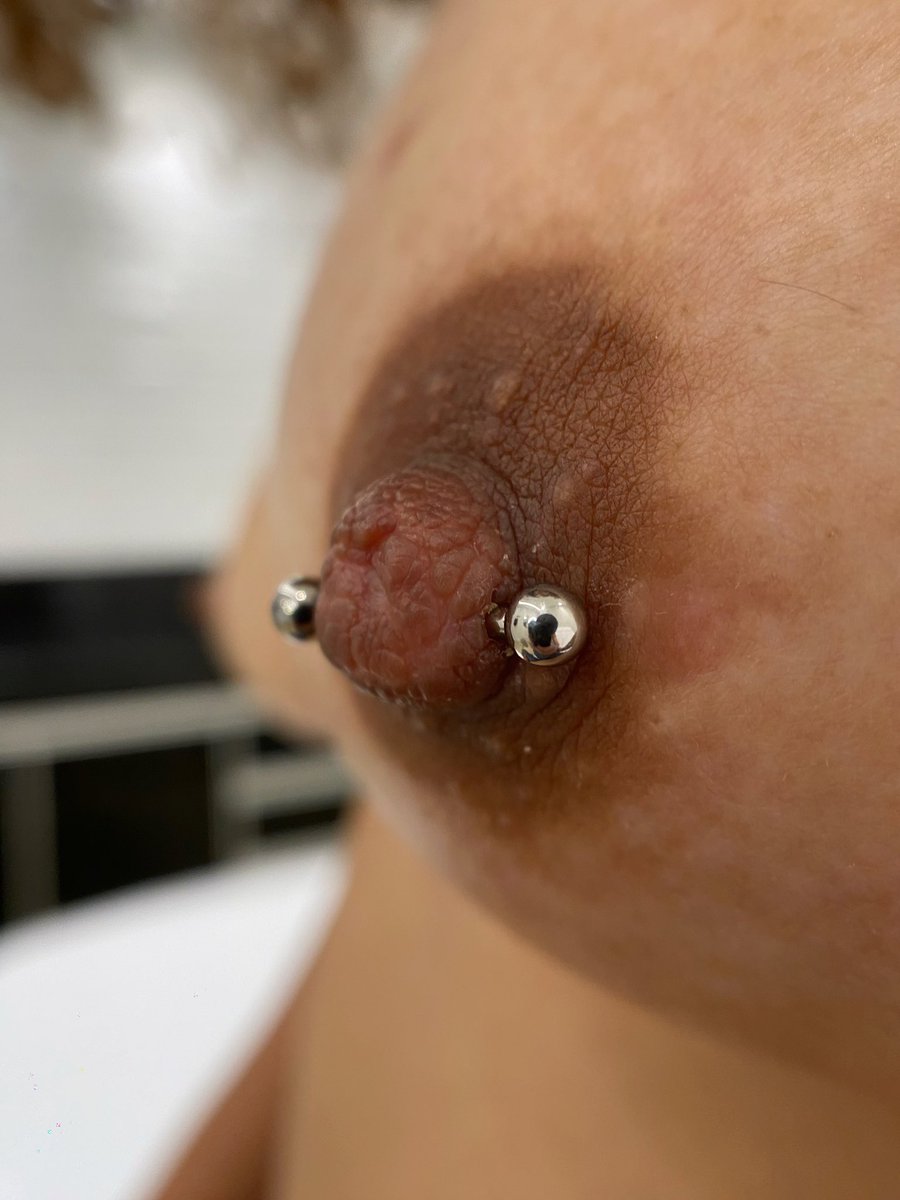 lolypiercer's tweet photo. Não fizemos foto do dia da perfuração, mas registramos no primeiro retorno com 30 dias. Olhem esse cuidado, essa cicatrização, que saudável &amp; lindaaaaa ❤️ https://t.co/8muayUKaiP