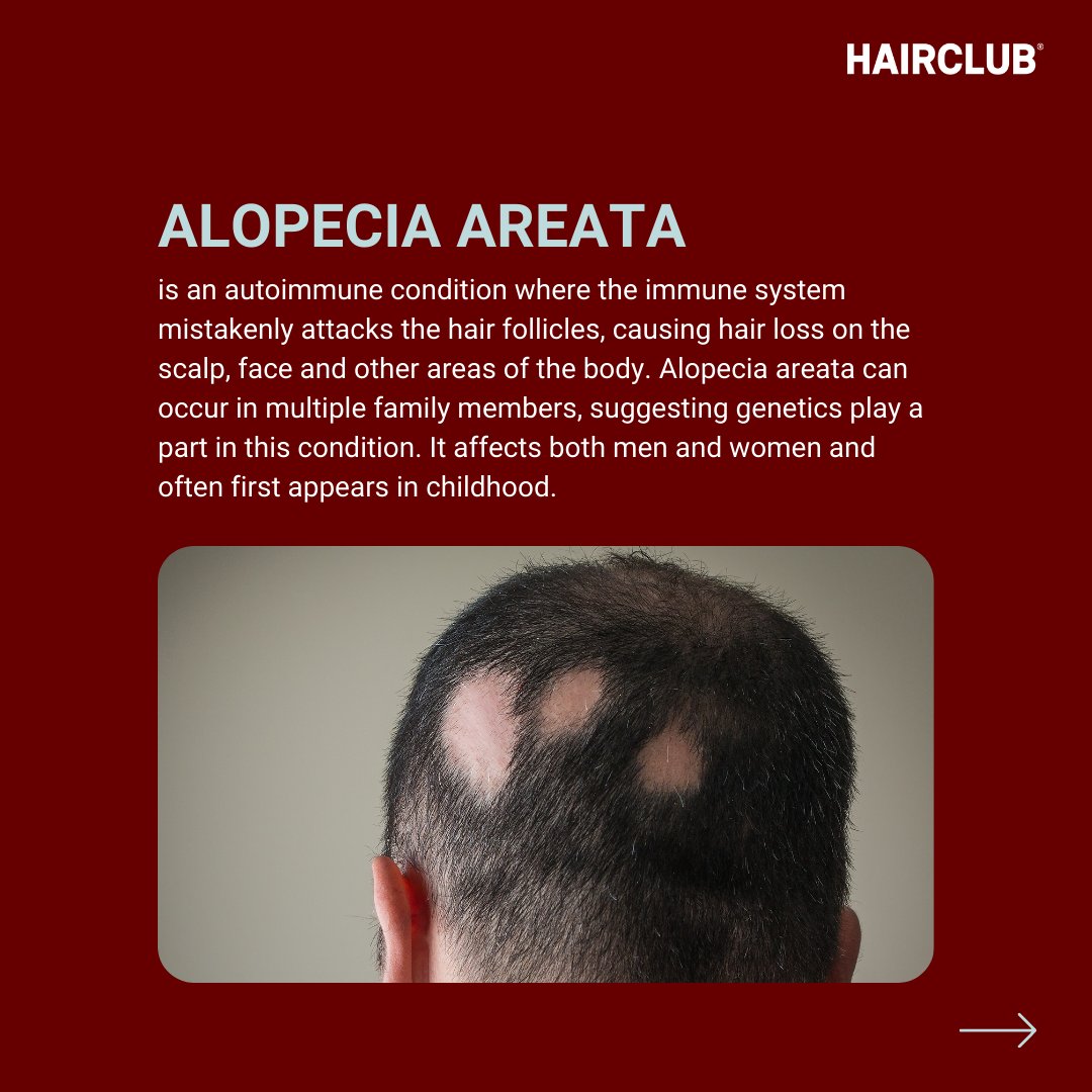 Join us in embracing diversity and supporting those who experience alopecia. Visit HairClubweb.com/hairloss to learn more. #hairclub #alopecia #alopeciaawareness #hairloss #confidence #hairlosssolution