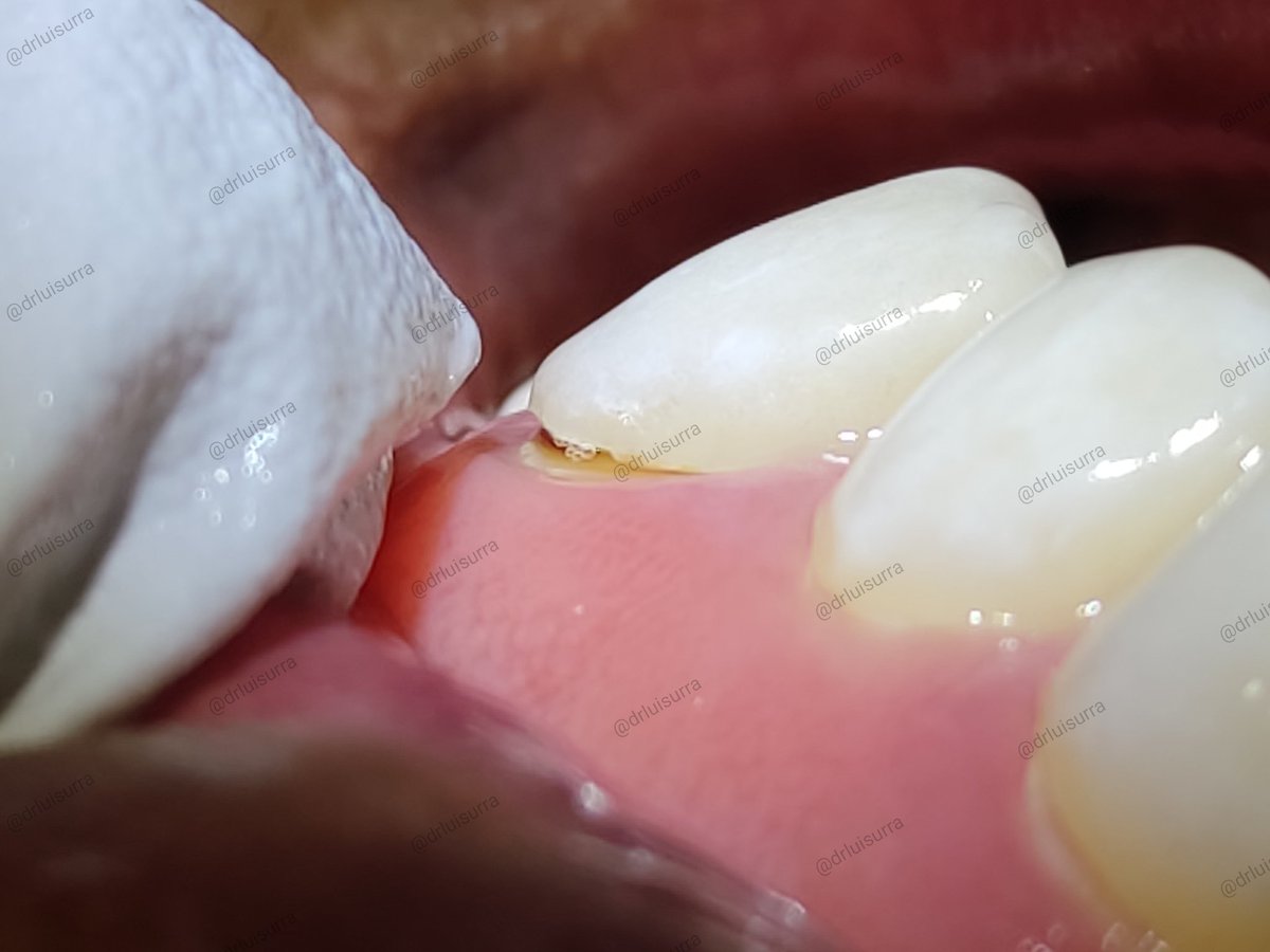 drluisurra's tweet photo. Recuerden, el colocar carillas a un paciente bruxista SIEMPRE lleva un riesgo. 😳😲

Este paciente acude con nosotros debido a que siente mal olor de boca 👄 y ya descubrimos la razón. 

#dentista #odontologia #dientesblancos #carillas #Irapuato #Guanajuato #esteticadental https://t.co/X5RggijDiK