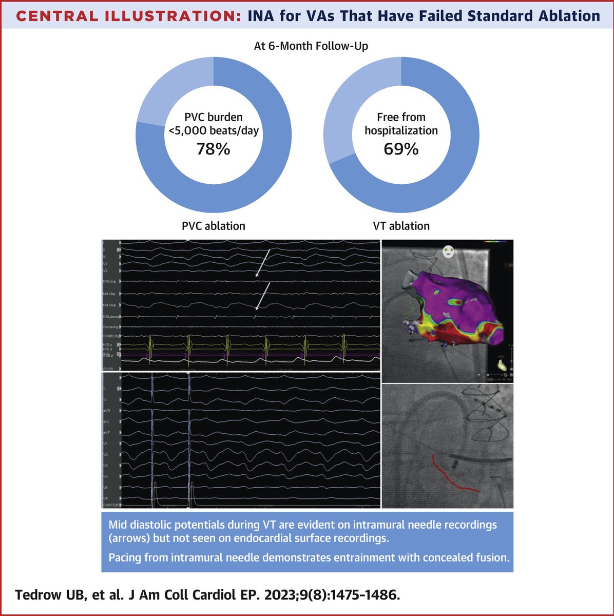 JACC Journals (@jaccjournals) on Twitter photo Worldwide experience with irrigated needle ablation of refractory ventricular arrhythmias! Read about it in #JACCCEP: bit.ly/3pWInH6
#EPeeps #CardioTwitter #epAblation <a href="/utedrow/">Usha Tedrow</a> <a href="/jskoruth/">Jacob Koruth</a> <a href="/UBatnyam_EP/">Uyanga Batnyam</a> <a href="/VivekReddyMD/">Vivek Y. Reddy</a> Worldwide experience with irrigated needle ablation of refractory ventricular arrhythmias! Read about it in #JACCCEP: bit.ly/3pWInH6
#EPeeps #CardioTwitter #epAblation <a href="/utedrow/">Usha Tedrow</a> <a href="/jskoruth/">Jacob Koruth</a> <a href="/UBatnyam_EP/">Uyanga Batnyam</a> <a href="/VivekReddyMD/">Vivek Y. Reddy</a>