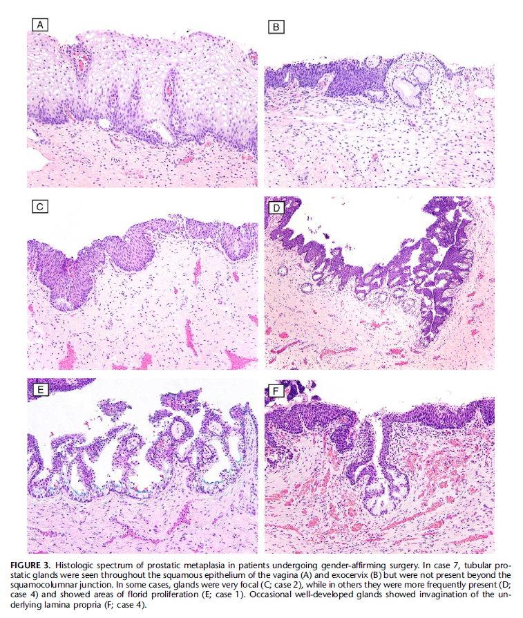 EliErlick's tweet photo. Today I learned that testosterone activates genes to grow prostate tissue. In one 2022 study, 100% of transmasculine subjects had prostate tissue after 1.4-12.1 years of testosterone therapy. https://t.co/YYOvq1L9cF https://t.co/lTEwe6CKLd