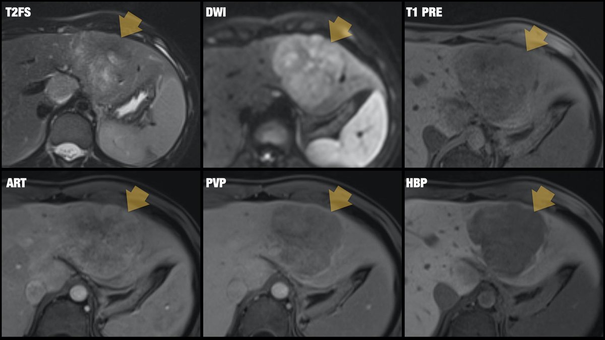 [2/2] Eovist/Primovist-enhanced liver MRI performed: heterogeneous mass, restricted diffusion, central scar with septa, no contrast uptake on hepatobiliary phase. Rare but classic! Diagnosis? <a href="/BrighamRad/">Brigham and Women's Radiology</a> @AURtweet <a href="/FOAMrad/">FOAMrad</a> <a href="/SAR_RFS/">SAR Resident and Fellow Section</a> <a href="/futureradres/">Future Radiology Residents</a> <a href="/HarvardMacy/">Harvard Macy</a> <a href="/CBRadiologia/">CBR</a> #MedEd