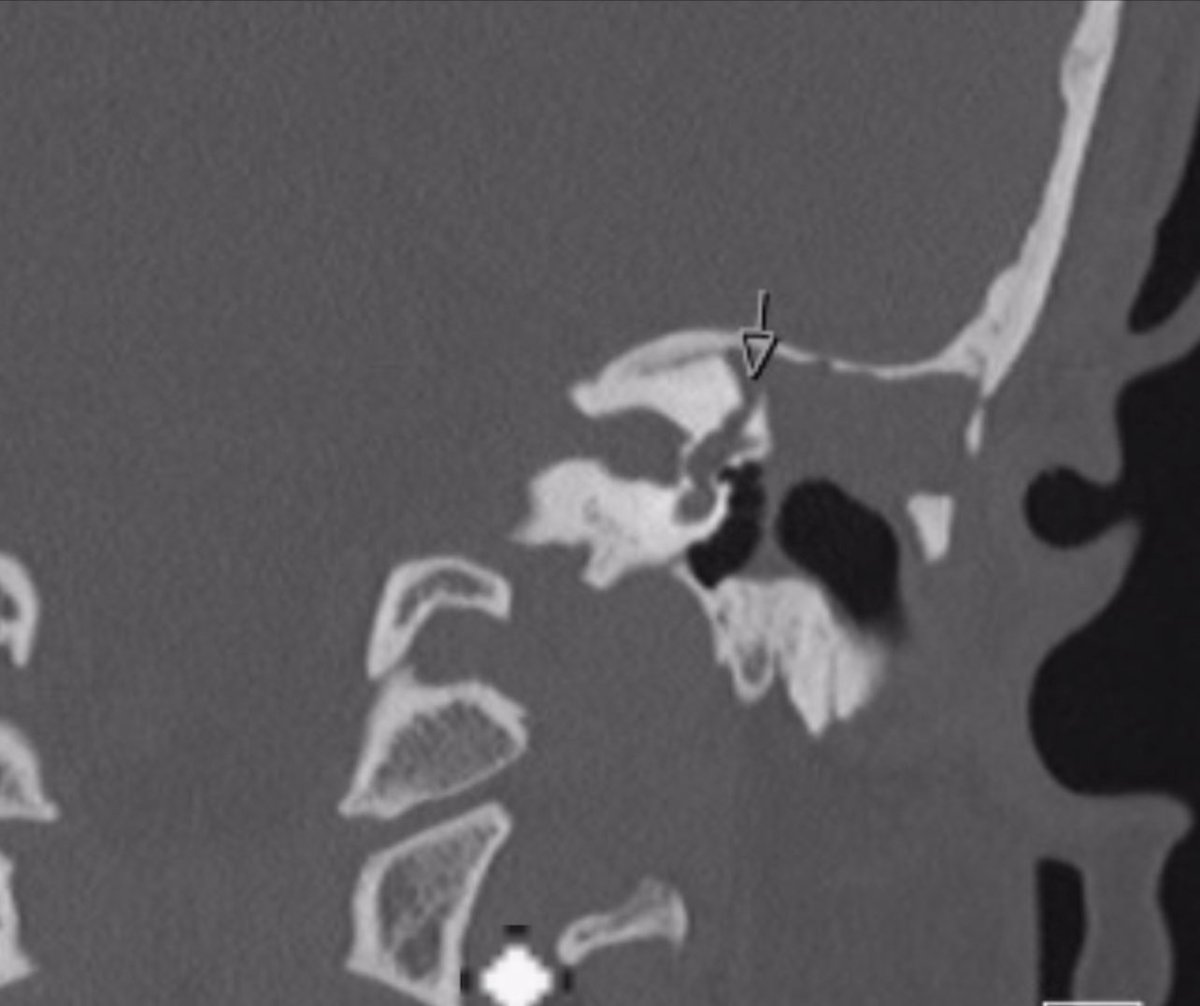 DrAhmaDSH's tweet photo. Left eye fistula sign secondary to SSC dehiscence caused by long standing Cholestatoma,  Notice vertical torsional movement of the left eye. https://t.co/3yFFRkd5S0