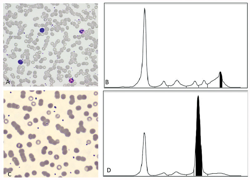 Now online @SemThrombHemost 'Same Syndrome, Different Causes and Treatment: Path to Diagnosis and Management of Two Interesting Cases of Acquired von Willebrand Syndrome' from Dr. Marta Monti @tfasano77 @AUSLRomagna #VWF #VWD #AVWS #bleeding #hemorrhage thieme-connect.de/products/ejour…