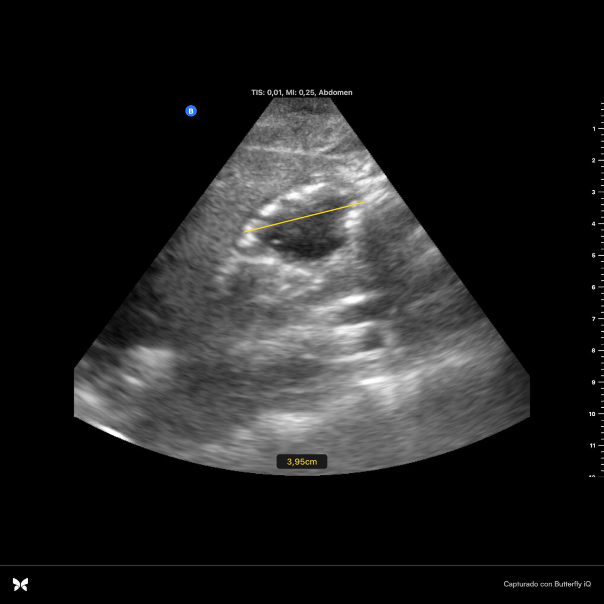 ANDRESMFC14's tweet image. En #PAIPA con @Periocrit y @SOBAYRE #POCUSFIRST #gastricultrasound