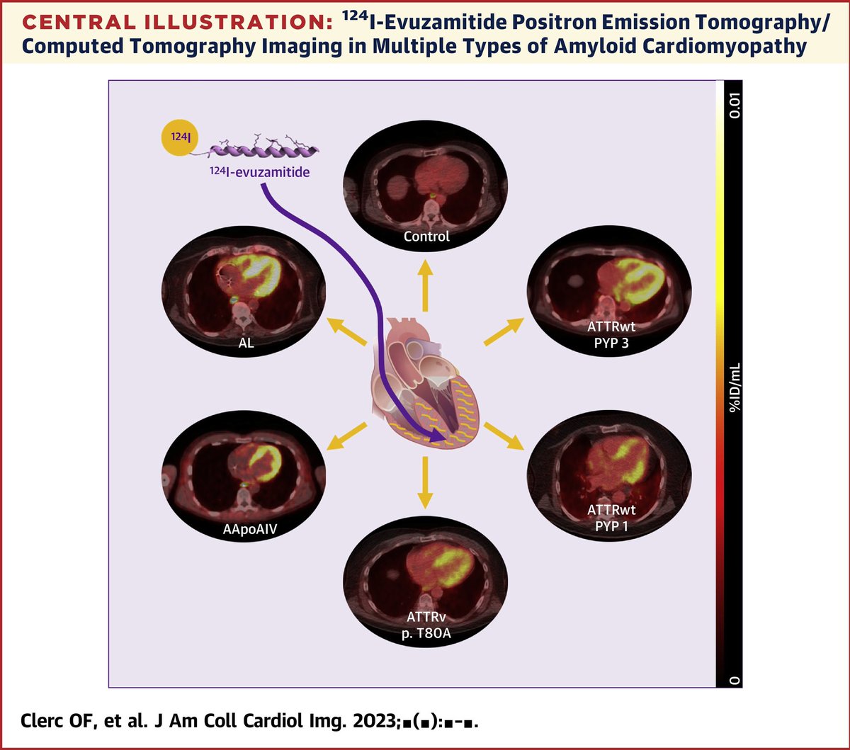 Ahmad Masri (@masriahmadmd) on Twitter photo Check out this exciting new investigation into the performance of AT-01 (124I-evuzamitide) PET/CT and a comparison to 18F florbetapir by <a href="/DorbalaSharmila/">Sharmila Dorbala</a> <a href="/sarahcud/">Sarah Cuddy</a> et al.
jacc.org/doi/10.1016/j.…
#CardioTwitter #CVNuc Check out this exciting new investigation into the performance of AT-01 (124I-evuzamitide) PET/CT and a comparison to 18F florbetapir by <a href="/DorbalaSharmila/">Sharmila Dorbala</a> <a href="/sarahcud/">Sarah Cuddy</a> et al.
jacc.org/doi/10.1016/j.…
#CardioTwitter #CVNuc