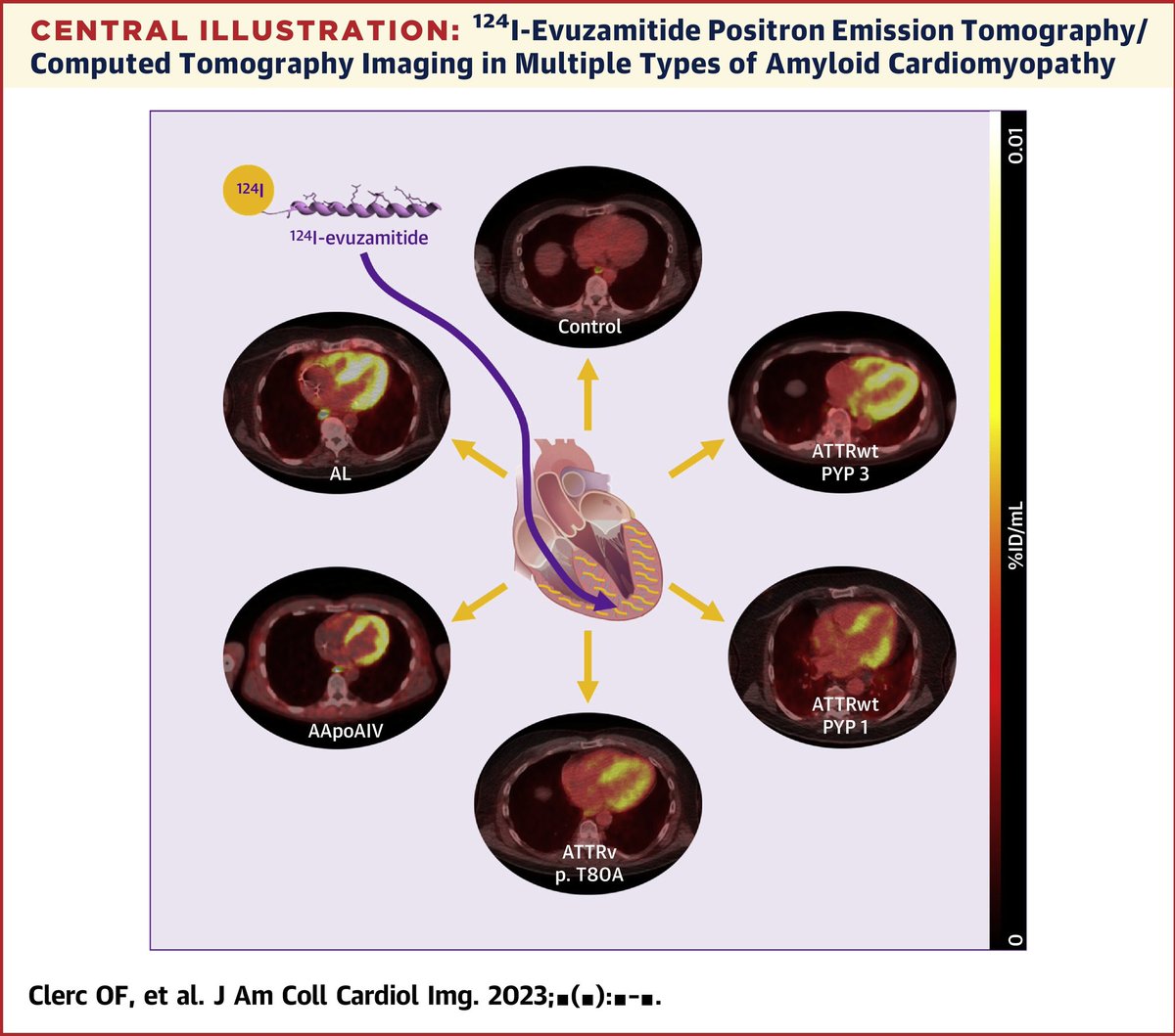 Check out this exciting new investigation into the performance of AT-01 (124I-evuzamitide) PET/CT and a comparison to 18F florbetapir by @DorbalaSharmila @sarahcud et al. jacc.org/doi/10.1016/j.… #CardioTwitter #CVNuc