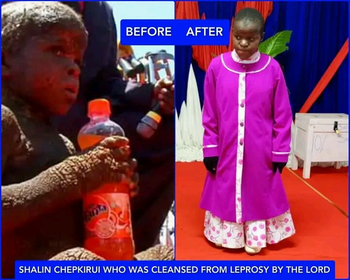 KemuntoLish's tweet photo. The cleansing of leprosy is still a wonder. Shalin Chepkirui is totally restored by JESUS and will soon sit for her KCPE national exam.

#TheIndelibleMiracles https://t.co/pWyWaFmjsP
