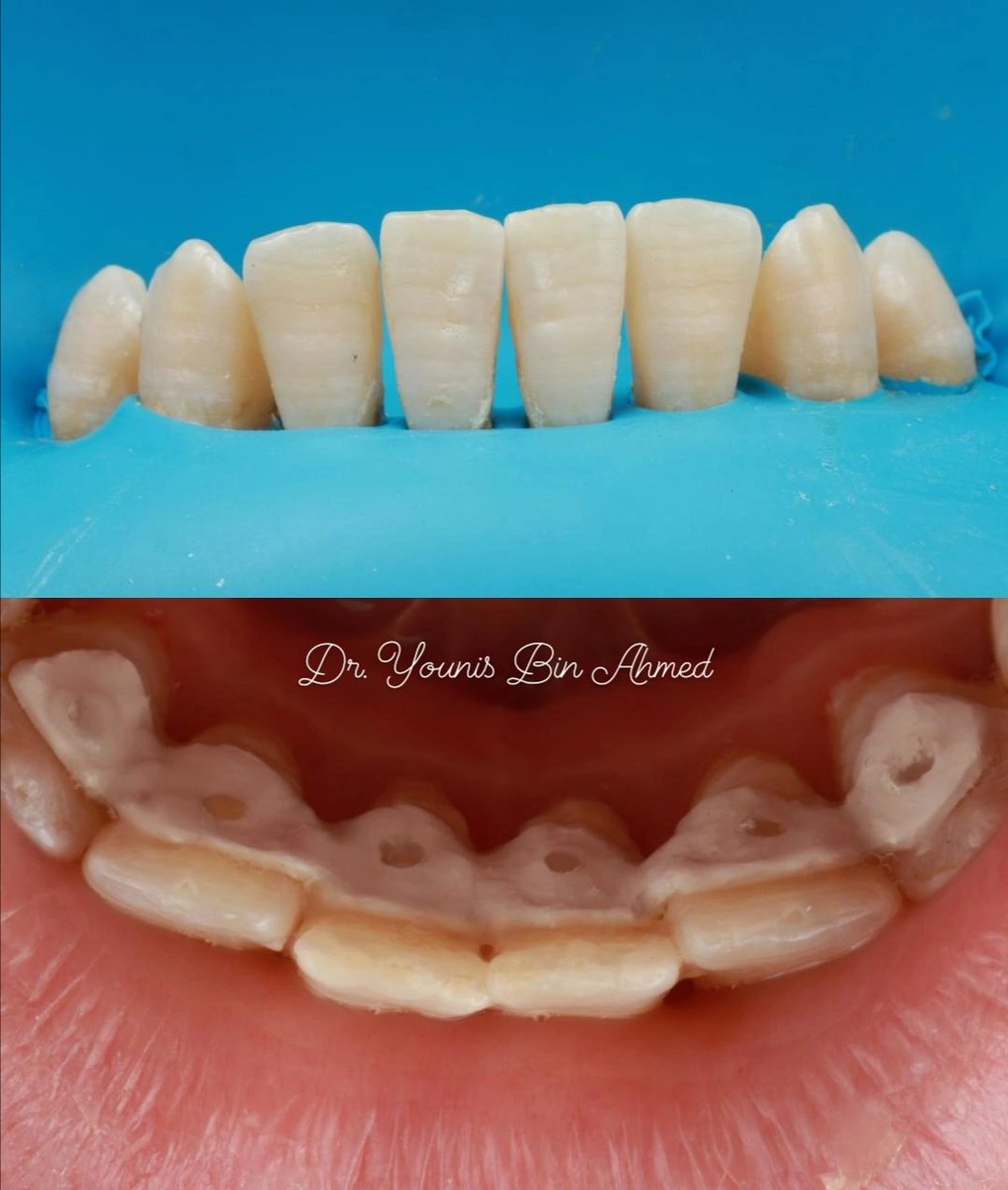 dentist_younis1's tweet image. I S O L 🅰️ T I O N 🖌️ to delivery peek #splint periodontally affected mobile anterior teeth🦷❗
#التجبير: هو شكل من أشكال العلاج يتم فيه تجبير الأسنان المتحركة معًا بعناية، مما يمنع الحركة. 
#Splinting: Treatment for Loose Teeth
🔘 Clampless rubber dam🙏🏻
