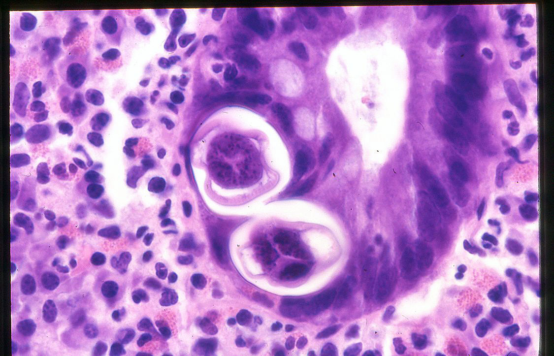 This image of colonic strongyloidiasis is courtesy of Dr. Dale Snover, who has retired from the University of Minnesota.