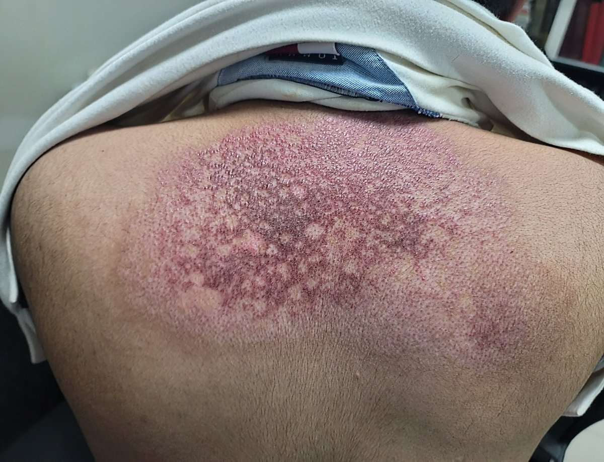 ConsejosReumato's tweet photo. La #dermatomiositis afecta #músculo (#miopatía proximal) y #Piel. A nivel cutáneo se puede ver #heliotropo, #rashmalar, pápulas de #Gottron, signo de la V e hiperpigmentación en la parte superior del dorso o signo "del manto o chal". #myositis #muscle #Skin #myopathy #skinrash https://t.co/KJErw1acg9