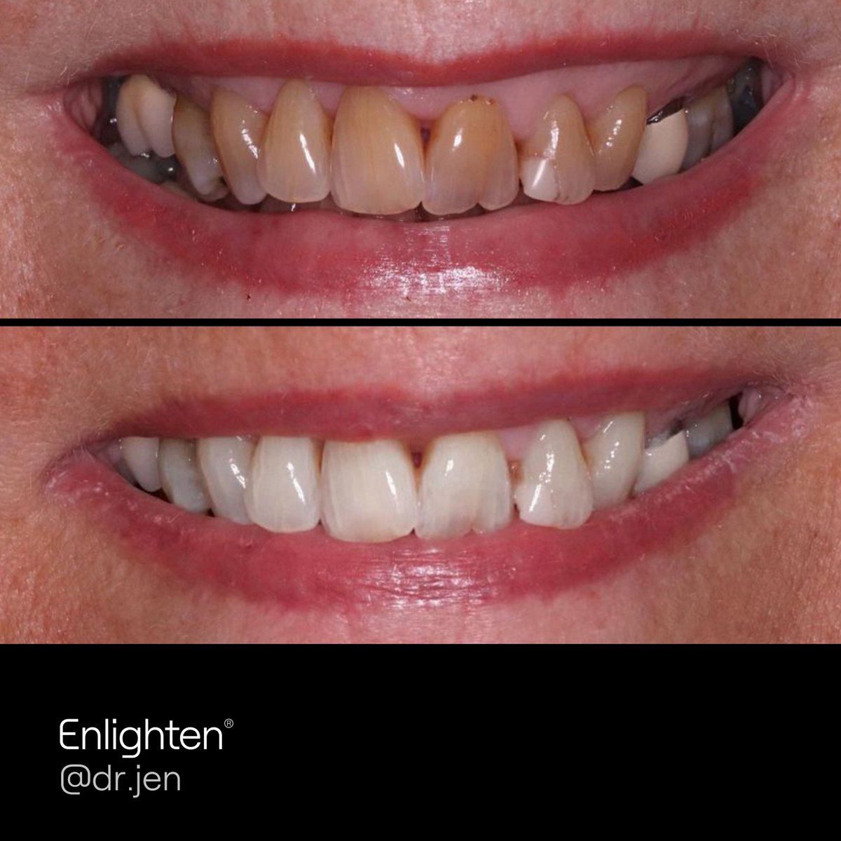 Prepare to be WOWed! 😲

Our Enlighten experts are constantly raising the bar of excellence with each and every case. 🙌 ✨ 

#enlightensmiles #enlighten #teethwhitening #enlightenexpert #evo4 #womeninbeauty #selfcare #skincare #smilecare