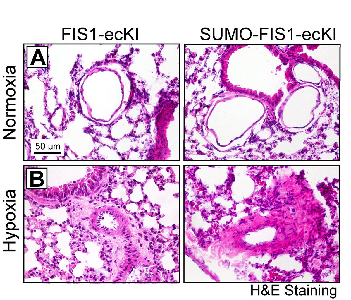 Zhou et al found that by maintaining endothelial #mitochondrial homeostasis #deSUMOylation of #FIS1 adaptively preserves #endothelial function against hypoxic stress and consequently protects against #PulmonaryHypertension. Learn more at ahajrnls.org/3EBpRYV