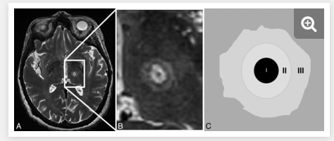 MichaelOkun's tweet photo. Can you have focused ultrasound therapy for PD or ET tremor and stay on your anticoagulants or antiplatelet drugs.  This new study by Rolston in 40 subjects is small, but says it is OK to stay on them. No complications.  https://t.co/3VPEhD7goE https://t.co/xeFA4o895O