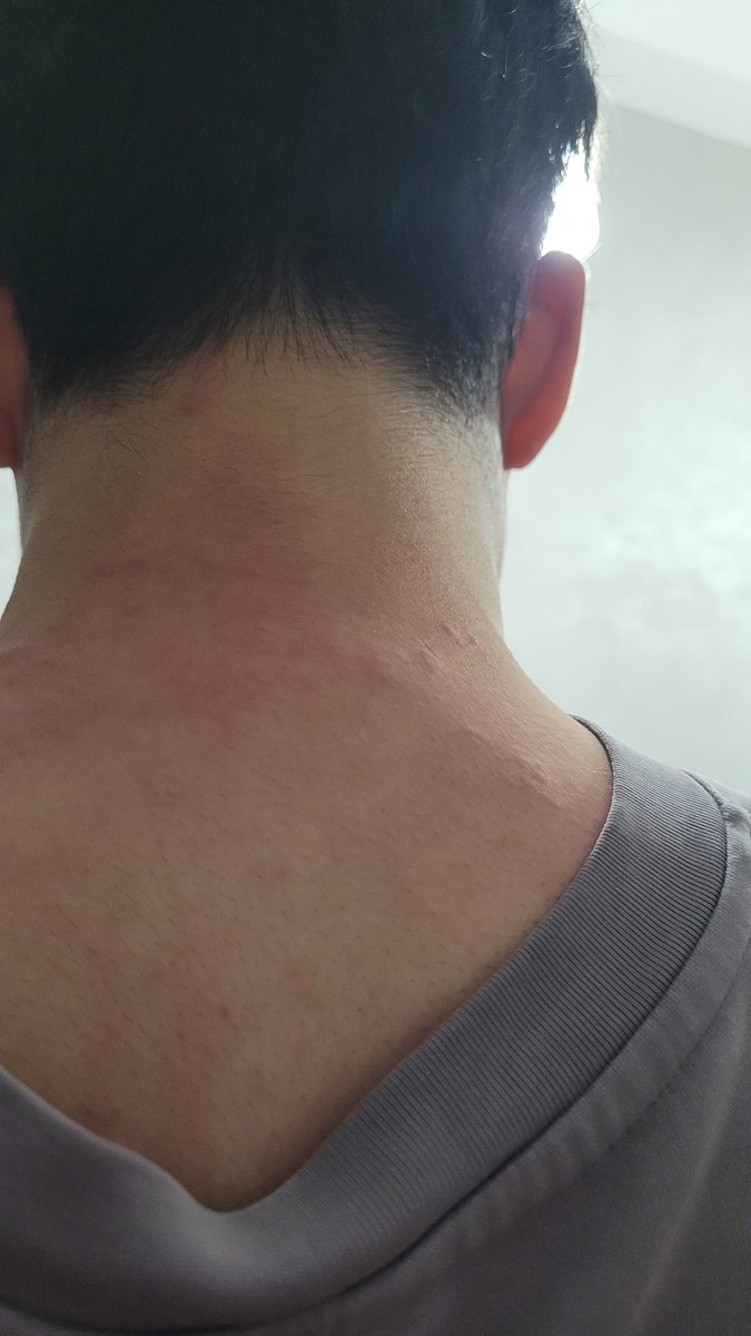 EL_CHOSO's tweet image. Merci @UGCcinemas pour les punaises de lit qui m'ont bien dévoré aux Halles 🥰