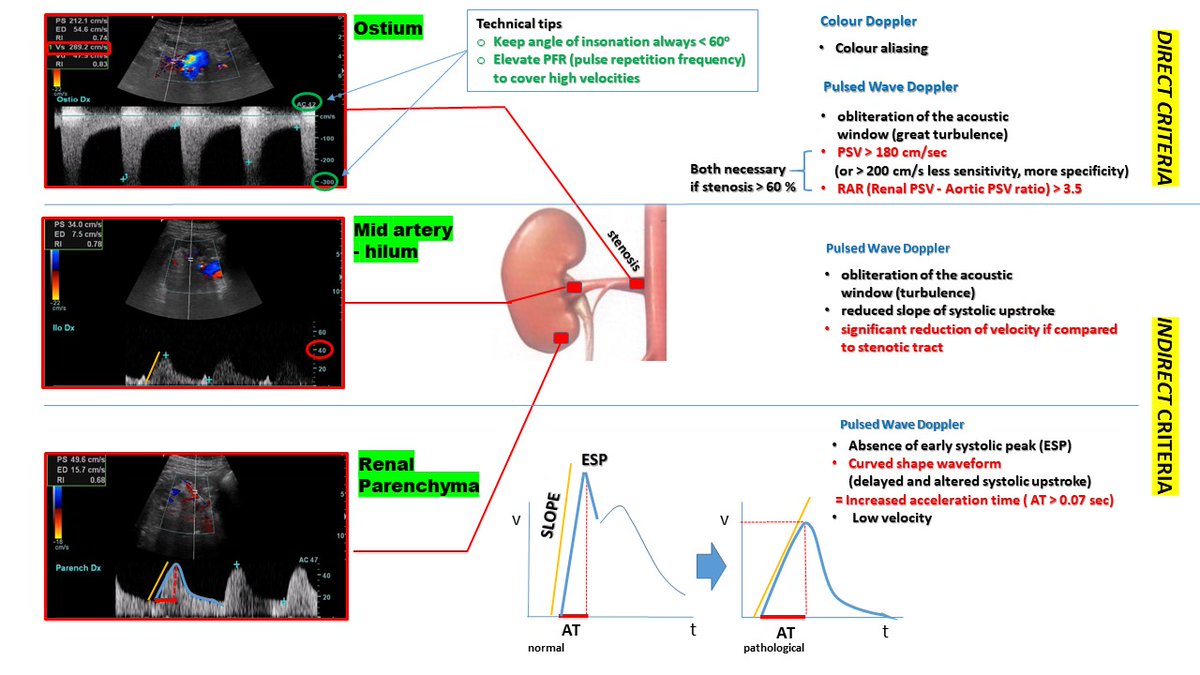 #POCUS #nephtwitter #nephpearls #MedTwitter 
Here 👇 the ANSWER to  
Renal Artery Stenosis (ostial) QUIZ  
...with an explanative panel for #Medstudent