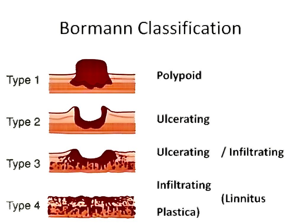 Boreman Classification The most commonly used classification method for gastric cancer is ...