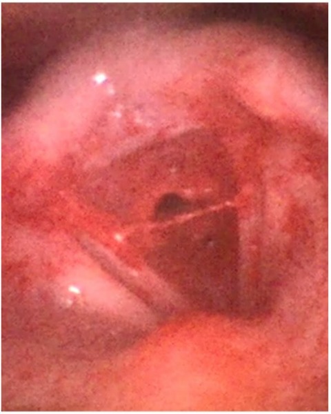 Mayo Clinic ENT (@mayoclinicent) on Twitter photo Should an otolaryngologist be consulted prior to nebulized TXA use in patients presenting with postoperative hemoptysis following laryngology procedures?
Click to read more: bit.ly/3Ewcrxc
#MayoClinicENTResearch <a href="/DaleEkbom/">Dale Ekbom</a> <a href="/JoshWiedermann/">Josh Wiedermann, M.D.</a> <a href="/drsemirrabayan/">Dr. Semirra Bayan</a> Should an otolaryngologist be consulted prior to nebulized TXA use in patients presenting with postoperative hemoptysis following laryngology procedures?
Click to read more: bit.ly/3Ewcrxc
#MayoClinicENTResearch <a href="/DaleEkbom/">Dale Ekbom</a> <a href="/JoshWiedermann/">Josh Wiedermann, M.D.</a> <a href="/drsemirrabayan/">Dr. Semirra Bayan</a>